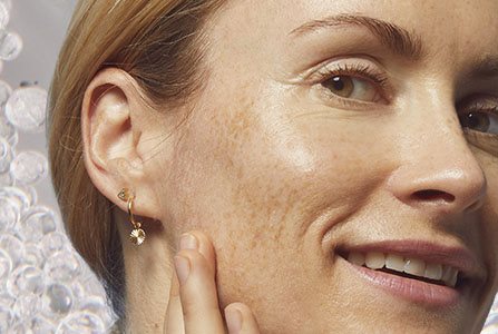 Prevenir la hiperpigmentación facial