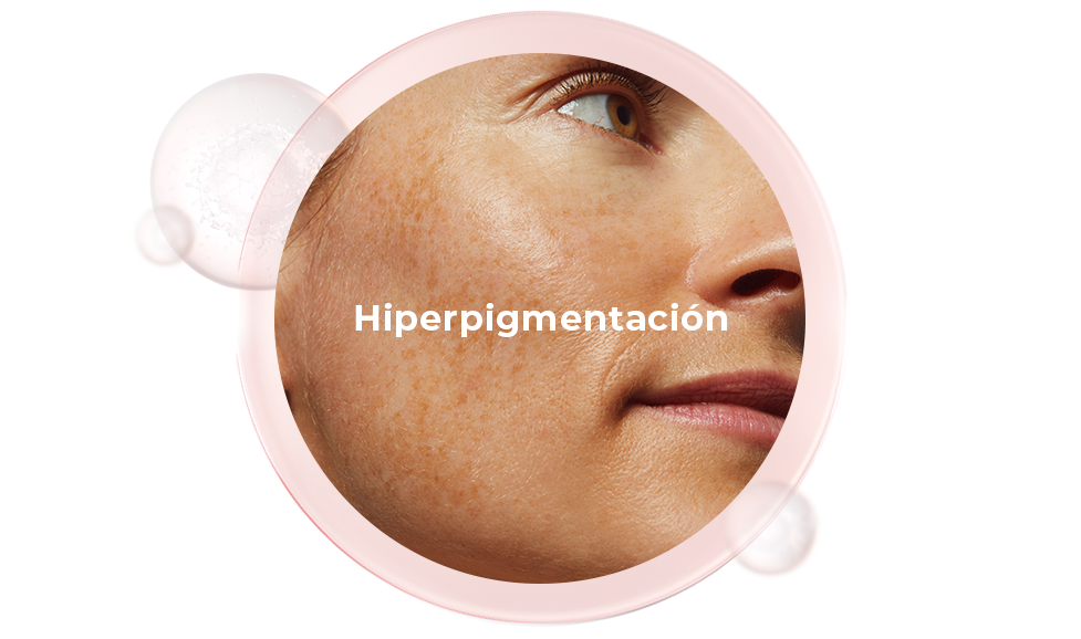 Hiperpigmentación