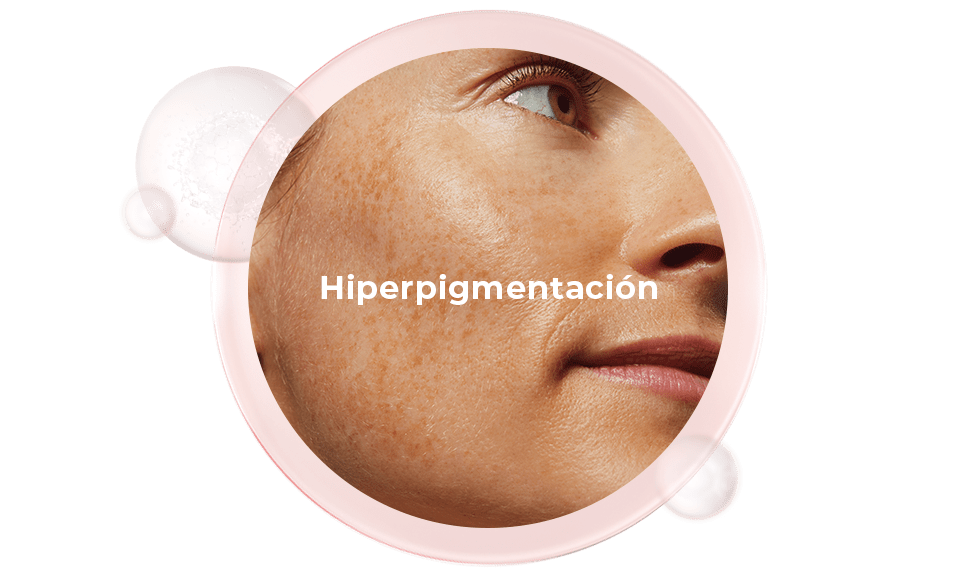 Hiperpigmentación