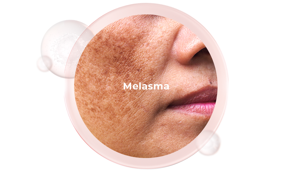 Melasma