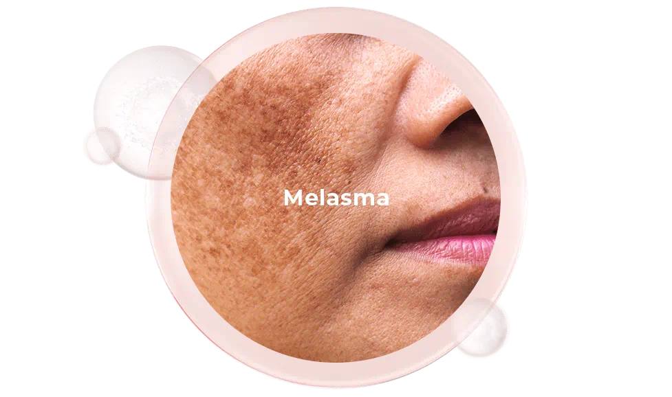 Melasma