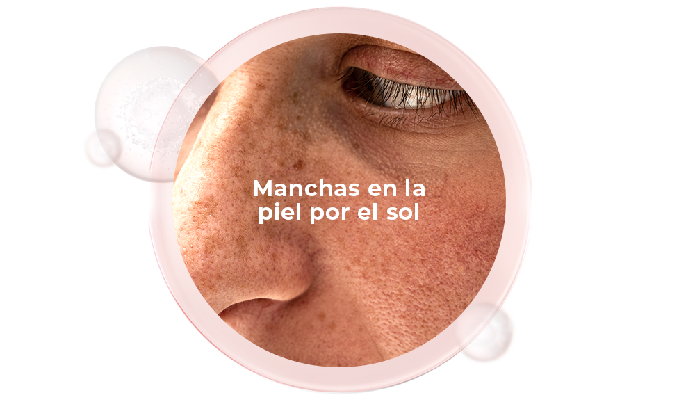Manchas en la piel por el sol