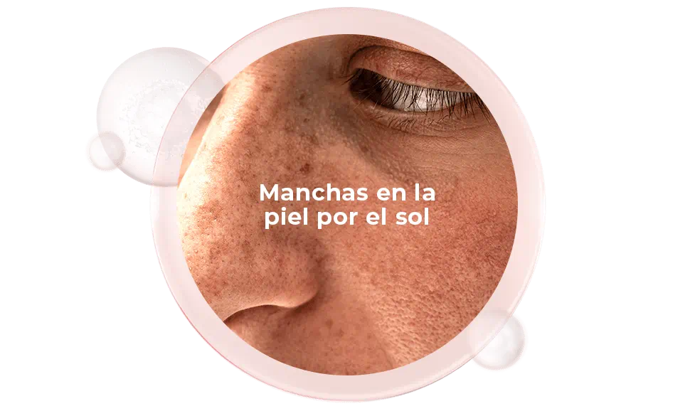 Manchas en la piel por el sol
