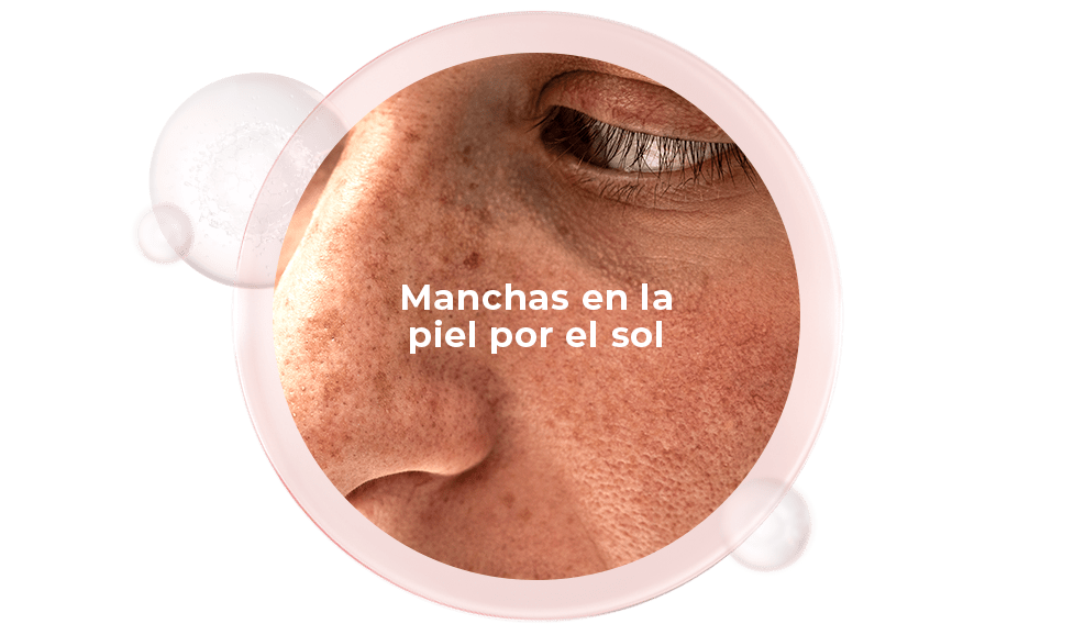 Manchas en la piel por el sol