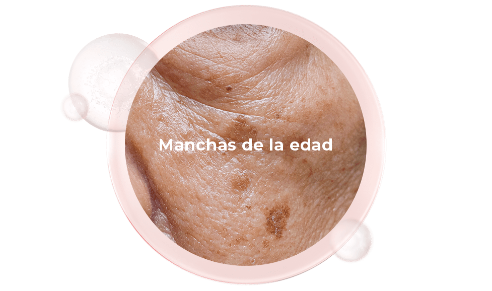 Manchas de la edad