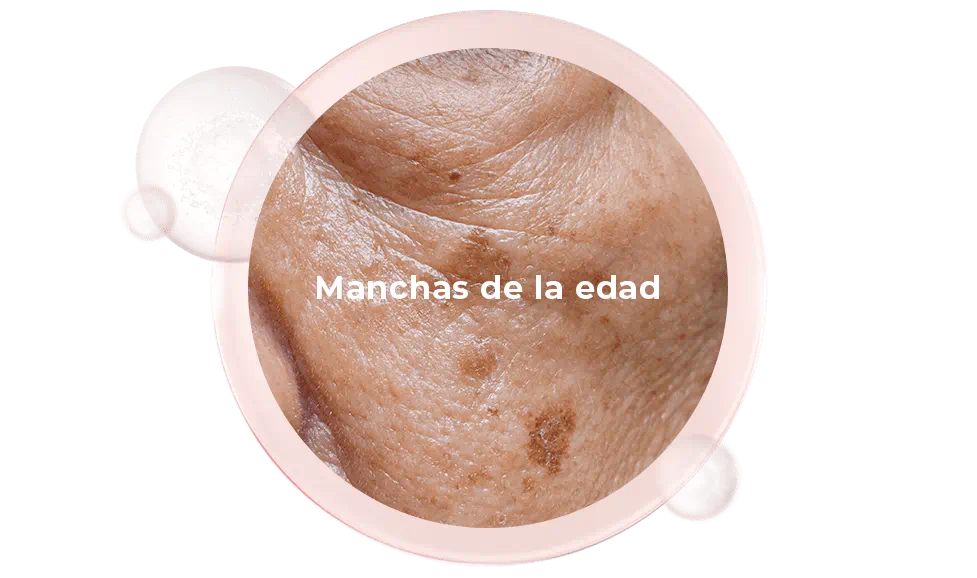 Manchas de la edad
