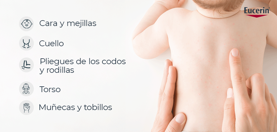 ¿Cómo se ve una piel con dermatitis atópica?