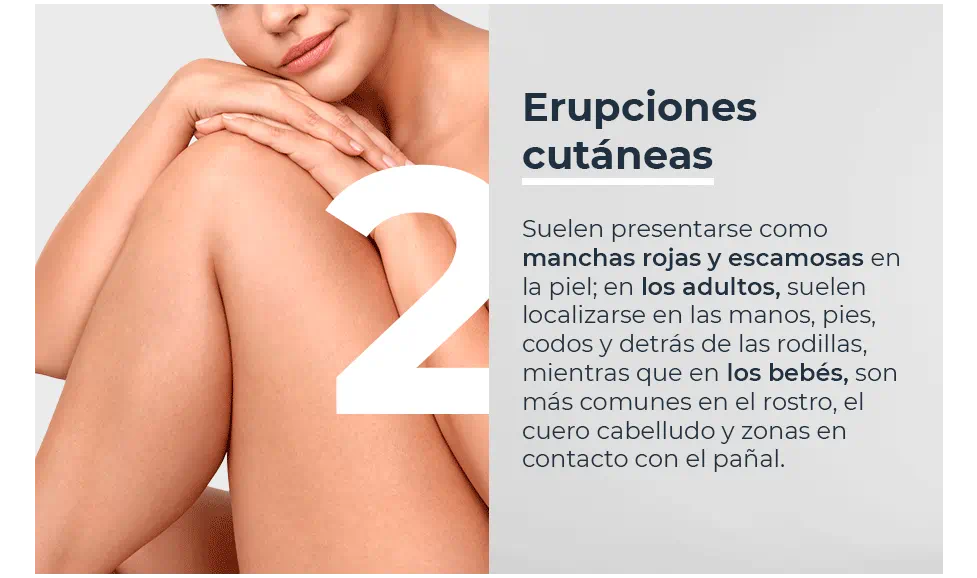 Erupciones cutáneas