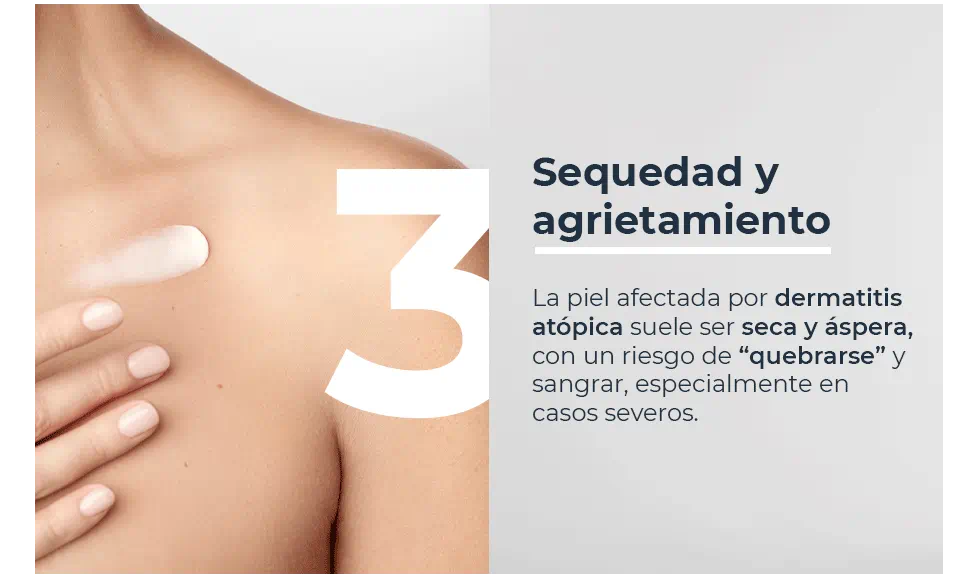 Sequedad y agrietamiento