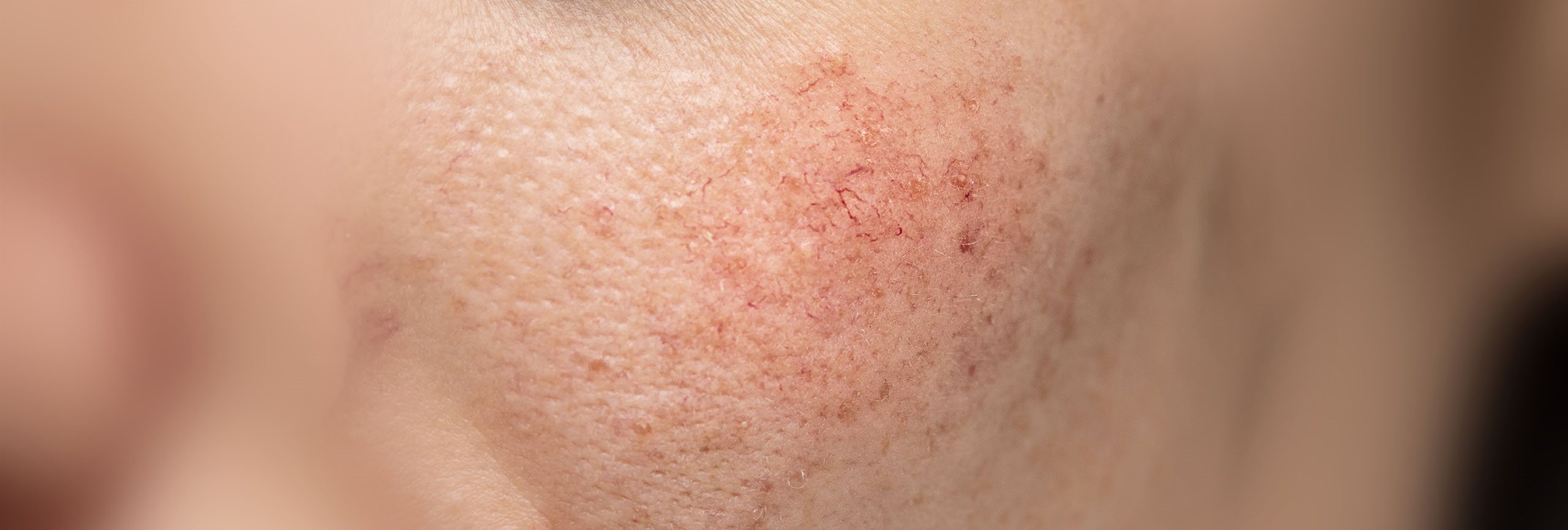 Chica con la piel sensible