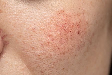 Chica con la piel sensible