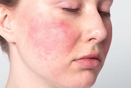Dermatitis atópica en la cara
