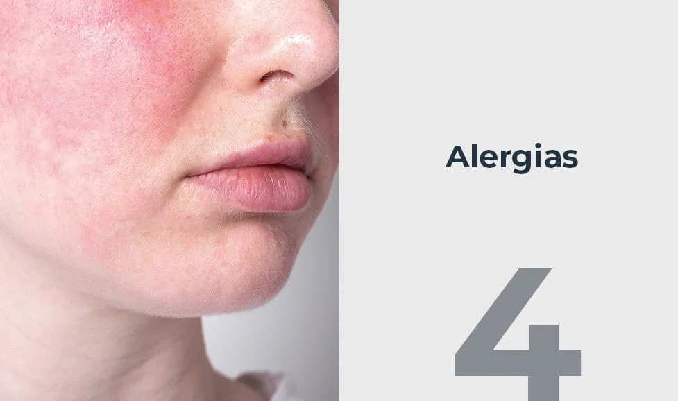 Alergias