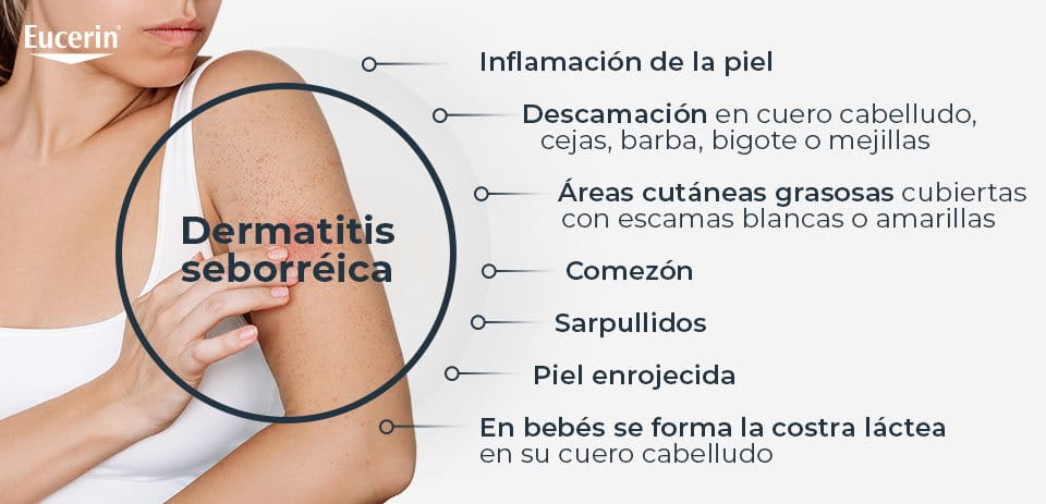 Síntomas de la Dermatitis Seborreica