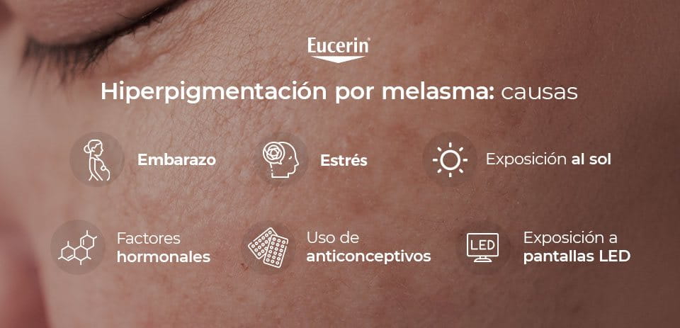 Hiperpigmentación por melasma