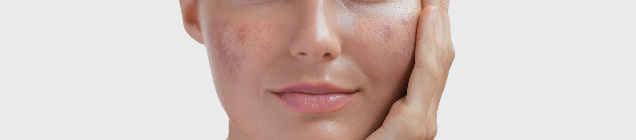 ¿Qué es el melasma?