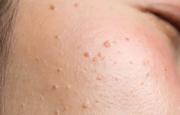 queratosis pilaris
