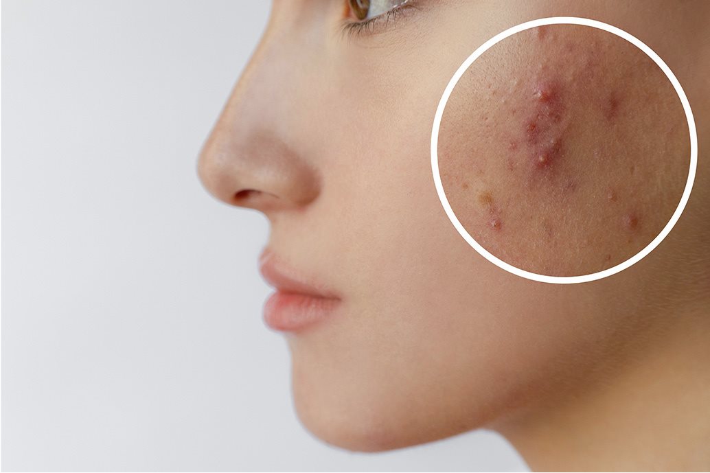 Primo piano di una ragazza con acne e imperfezioni sulla guancia