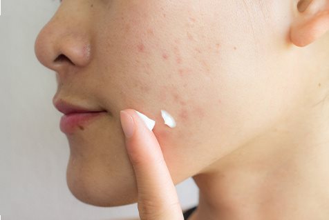 brufoli sulla guancia sinistra