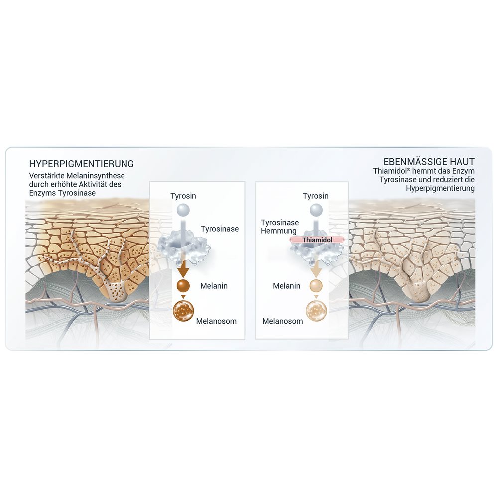 Grafische Darstellung der Tyrosinase. Auf dem linken Bild ist dargestellt, wie Hyperpigmentierung entsteht: Eine erhöhte Aktivität des Enzyms Tyrosinase führt zu einer verstärkten Melaninsynthese, was zur Bildung von Melanin und einer sichtbar dunkleren Pigmentierung der Haut führt. Auf dem rechten Bild ist die Wirkweise von Thiamidol dargestellt: Es hemmt das Enzym Tyrosinase, wodurch die Hyperpigmentierung reduziert wird.