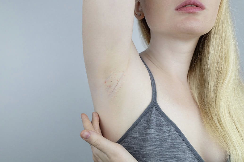 foto di ragazza con psoriasi ascelle