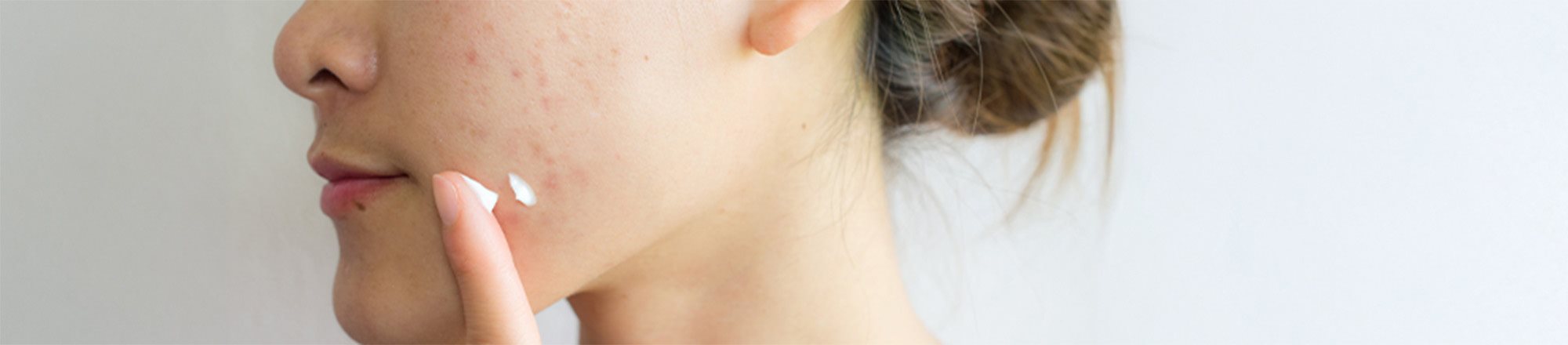 brufoli sulla guancia sinistra