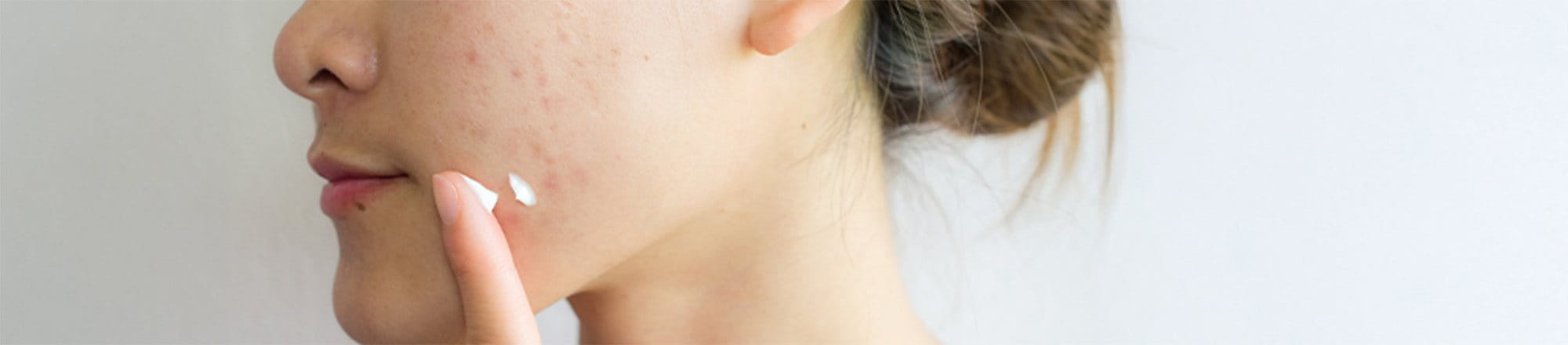 brufoli sulla guancia sinistra