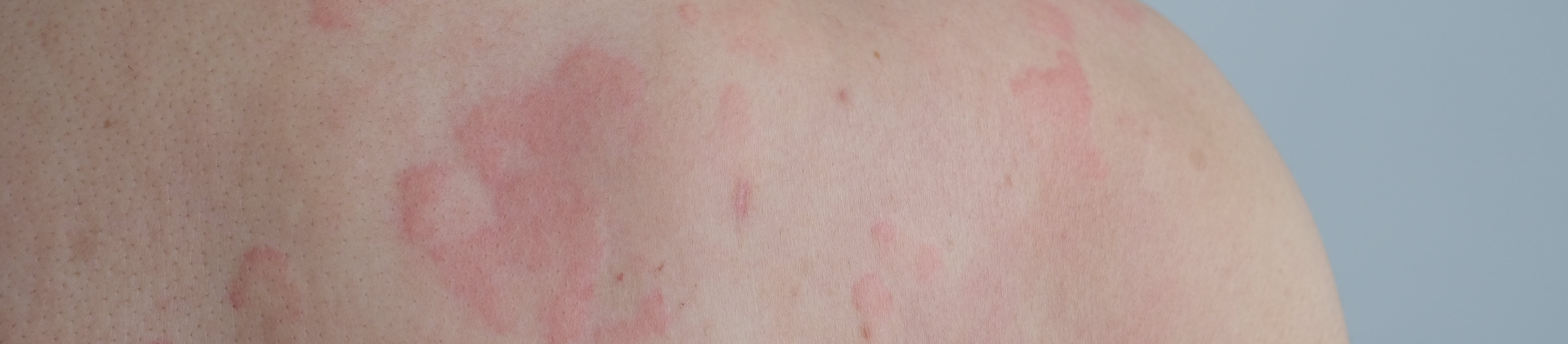 Rückenansicht eines Mannes mit roten Flecken auf der Schulter.