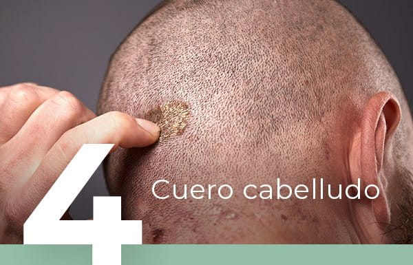 Granos en el cuero cabelludo