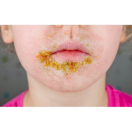 Kind mit gelber Kruste im Gesicht. 