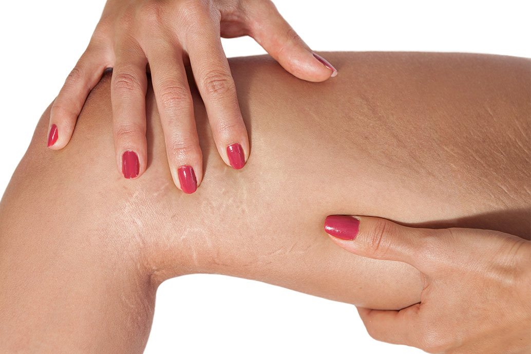 smagliature cosce interne