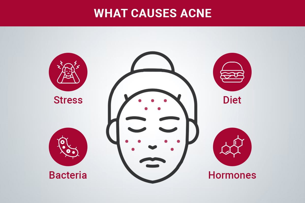 Acne Causes on skin
