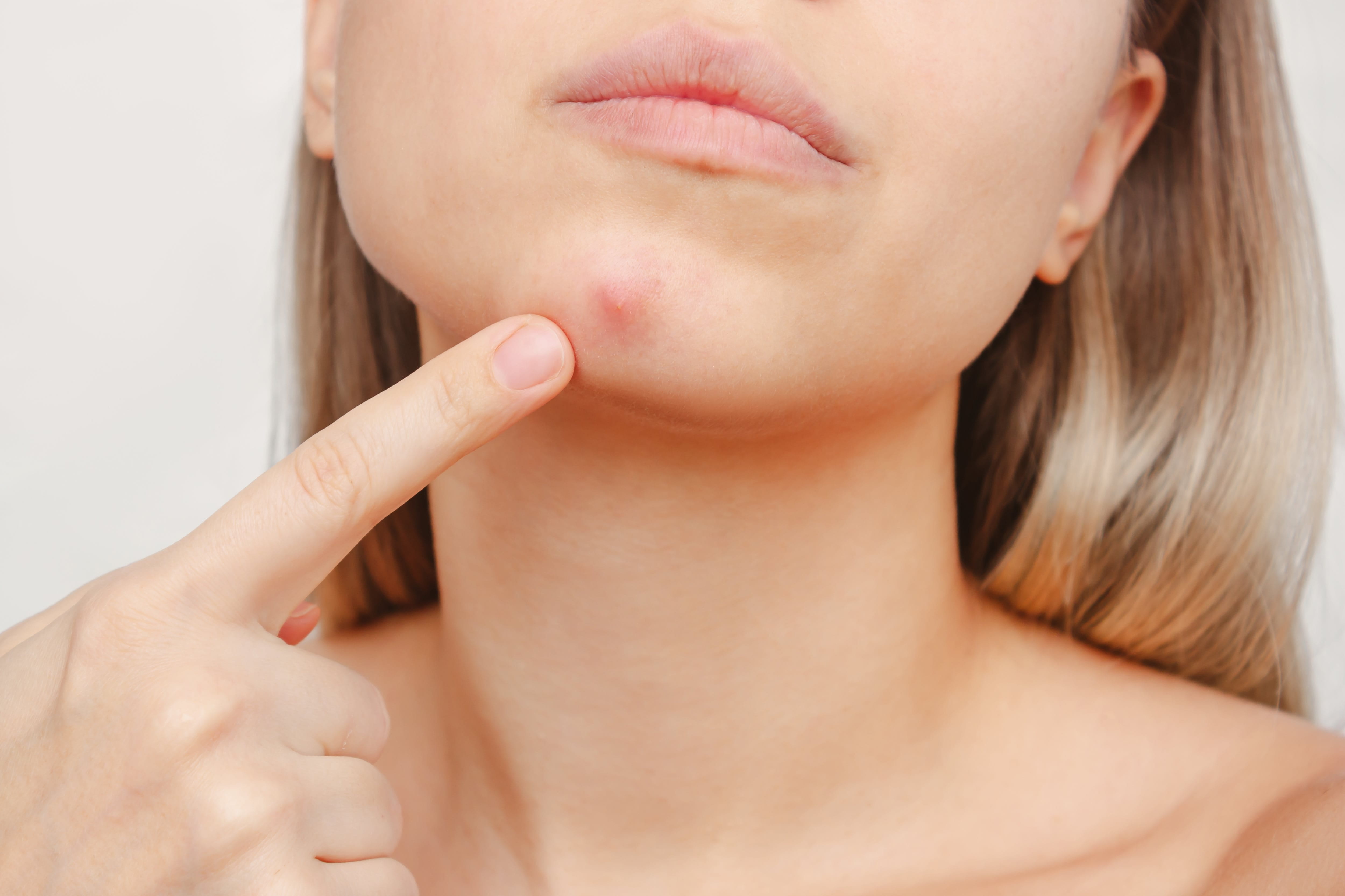Frau deutet mit dem Finger auf einen Pickel unterhalb der Lippe.