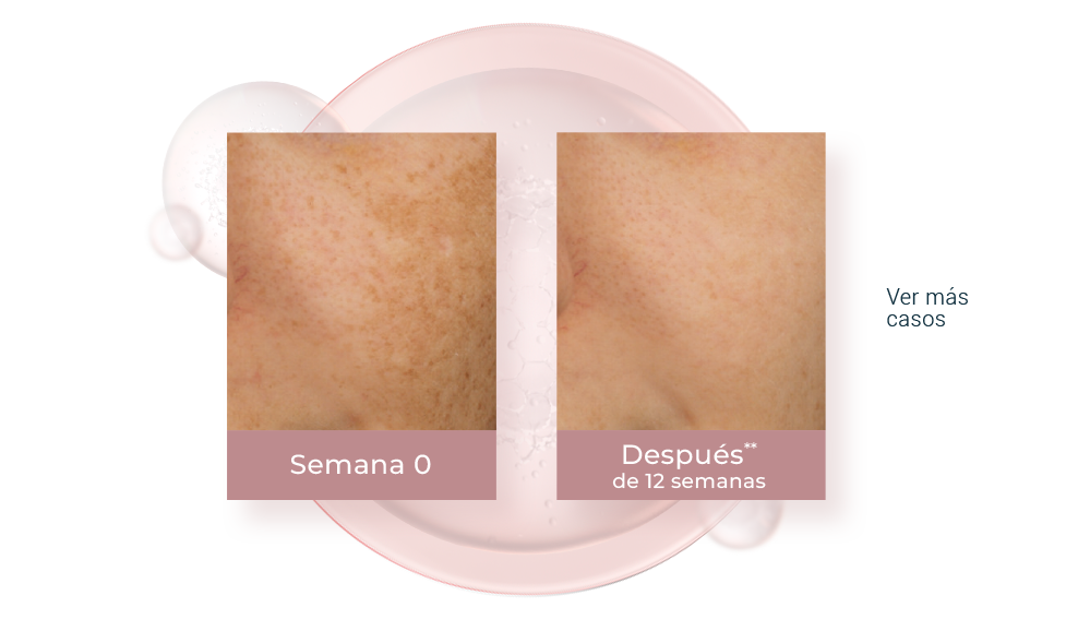 Resultados del uso de Dual Serum en 12 semanas