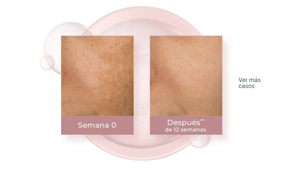 Resultados después de 12 semanas de uso