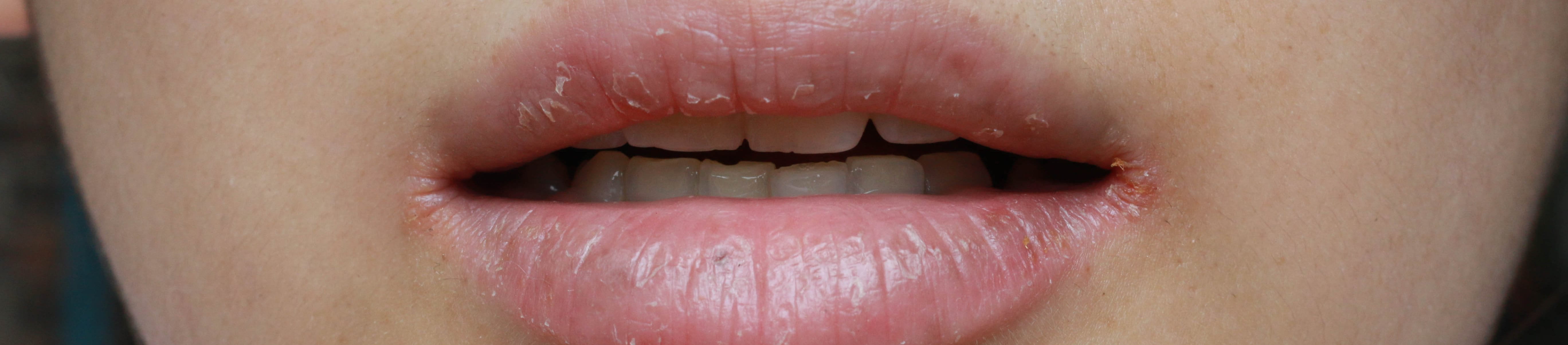 Nahaufnahme der Mundpartie eines Mädchens mit Neurodermitis an den Lippen und eingerissenen Mundwinkeln