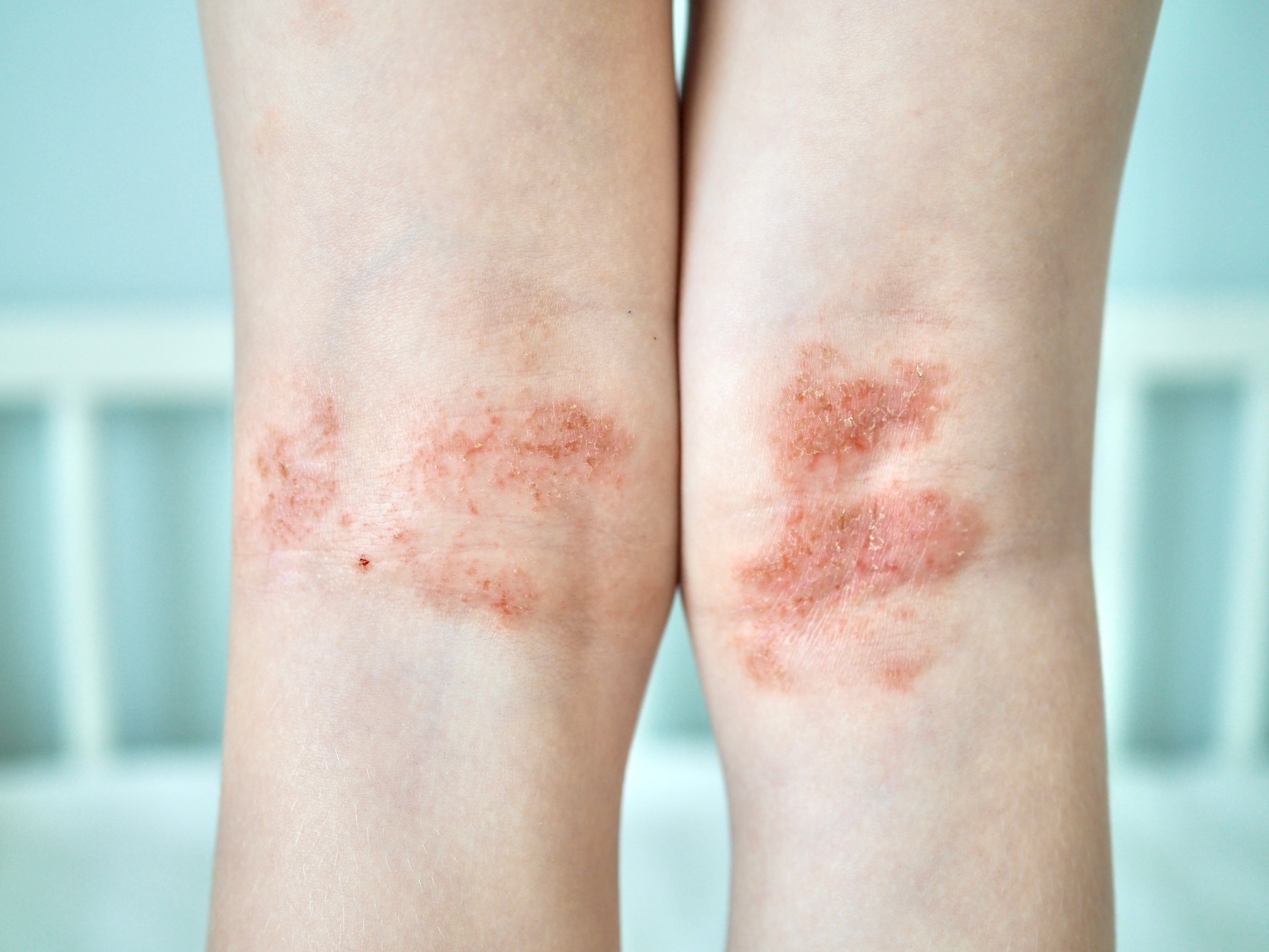 Rote Hautflecken in den Kniekehlen bei Psoriasis inversa
