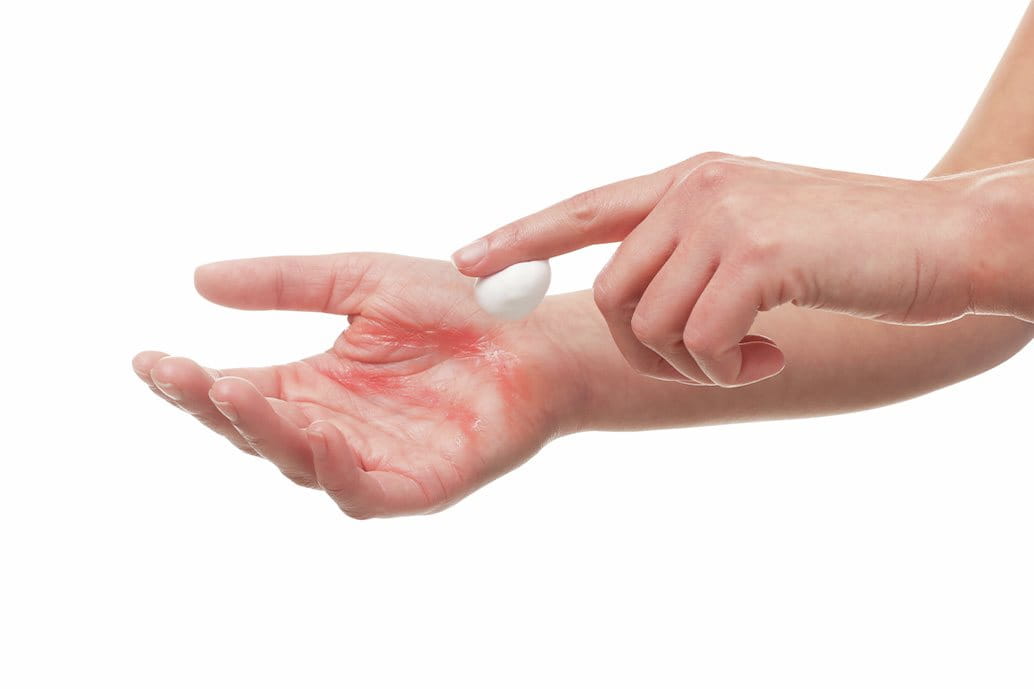 ragazza che applica crema su mano con psoriasi