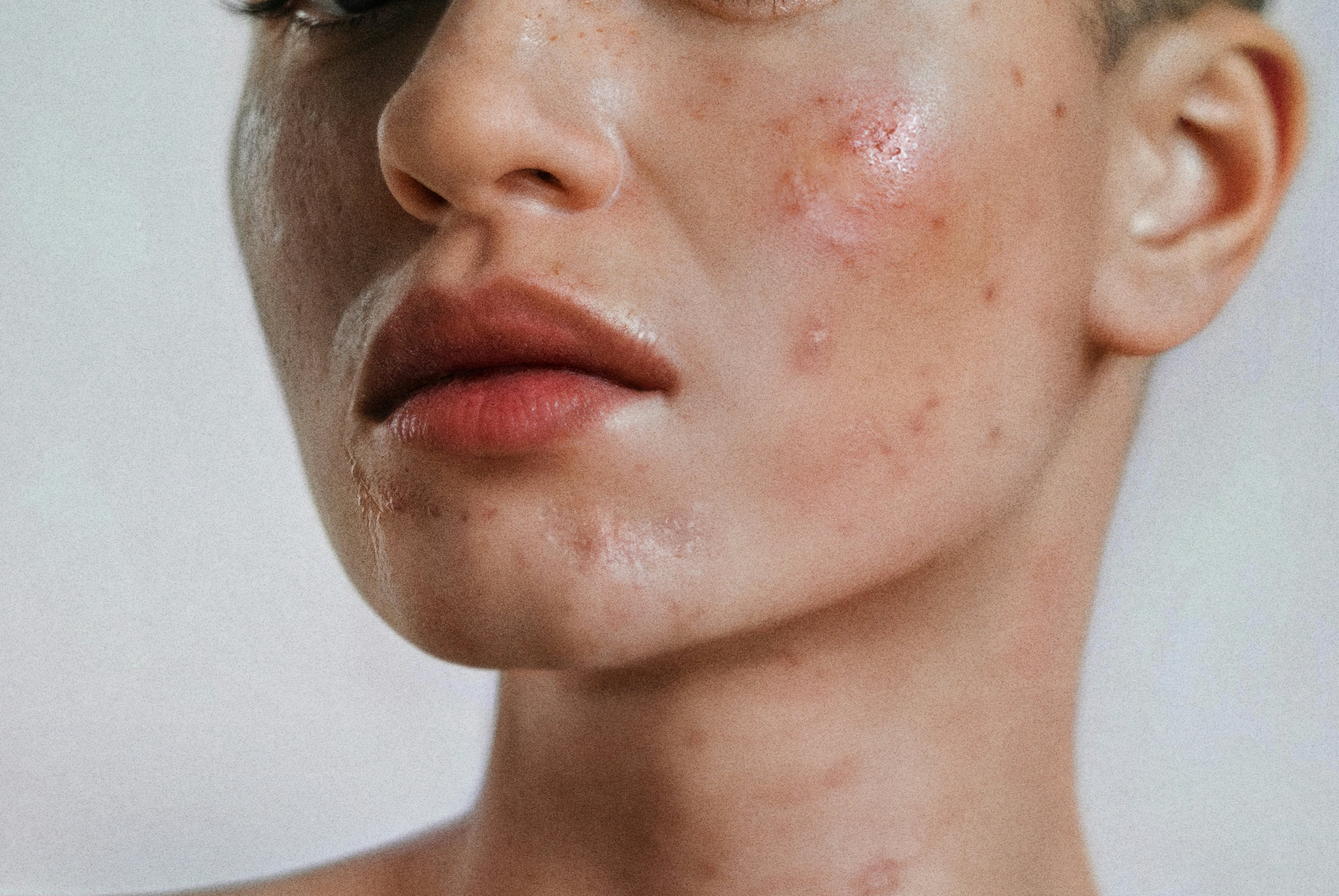 A woman with skin purging