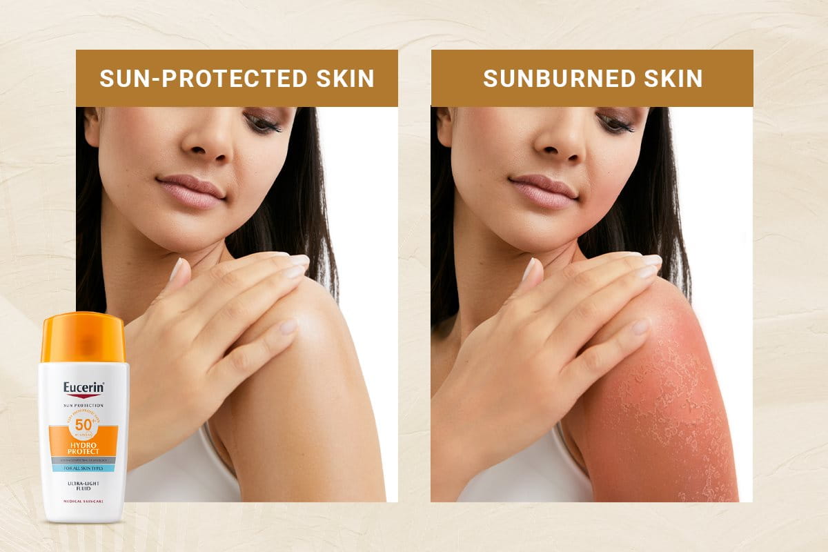 Sun protected Skin vs Sunburned skin