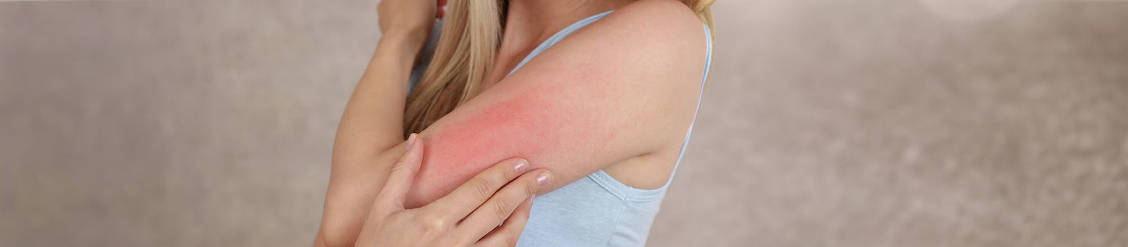 Orticaria solare sul braccio