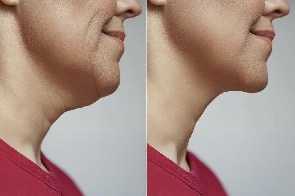 chirugia plastica doppio mento donna