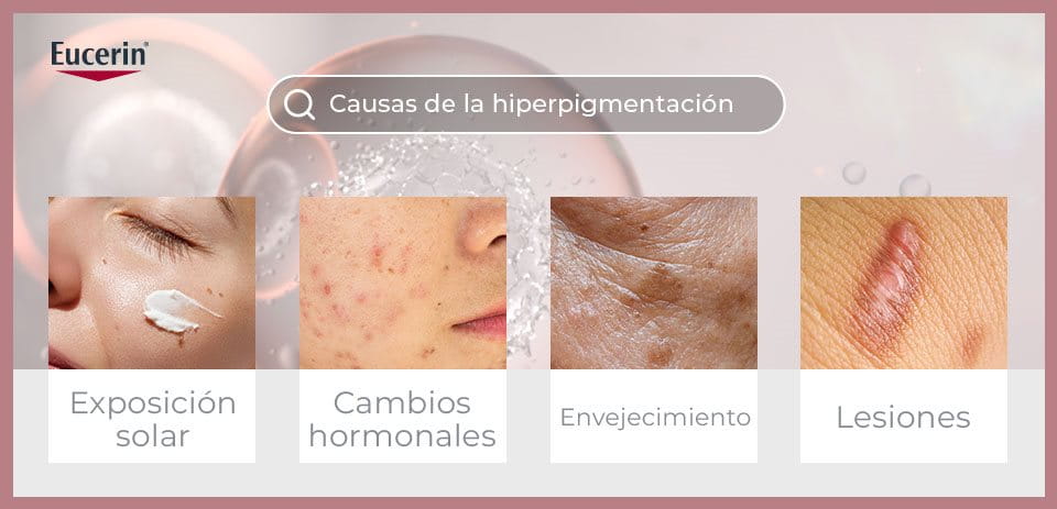 causas de la hiperpigmentación en la 