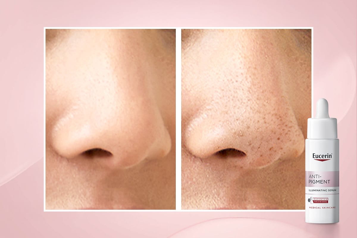 Filament on face treatment