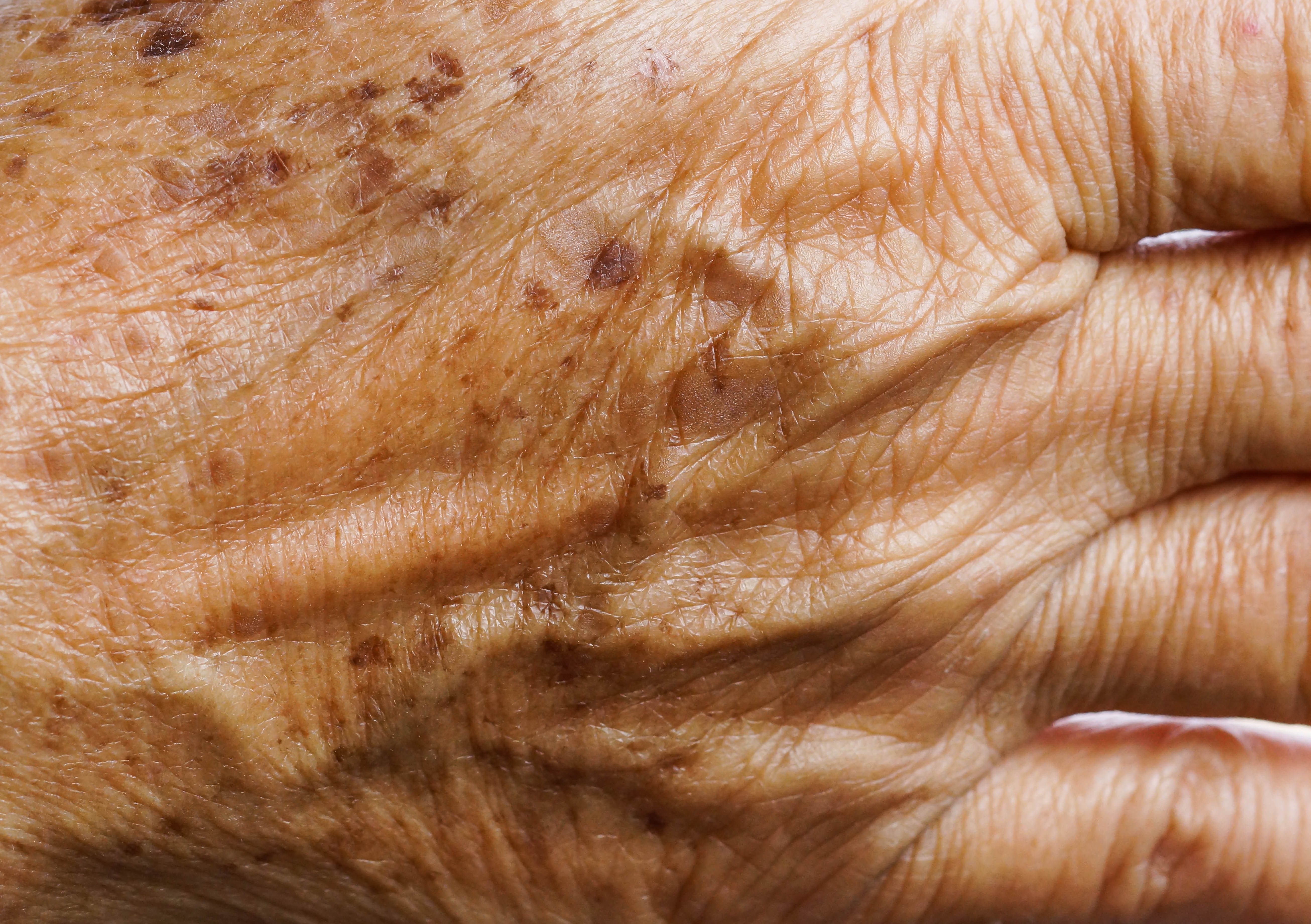 Nahaufnahme der Hand einer alten Person mit atrophischer Haut und Altersflecken.