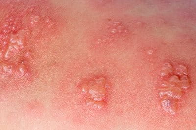 Phytophotodermatitis