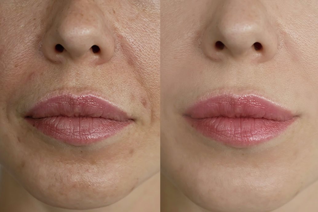 Confronto prima e dopo l’esfoliazione: pelle con pori dilatati e incarnato irregolare a sinistra, pelle liscia e uniforme 