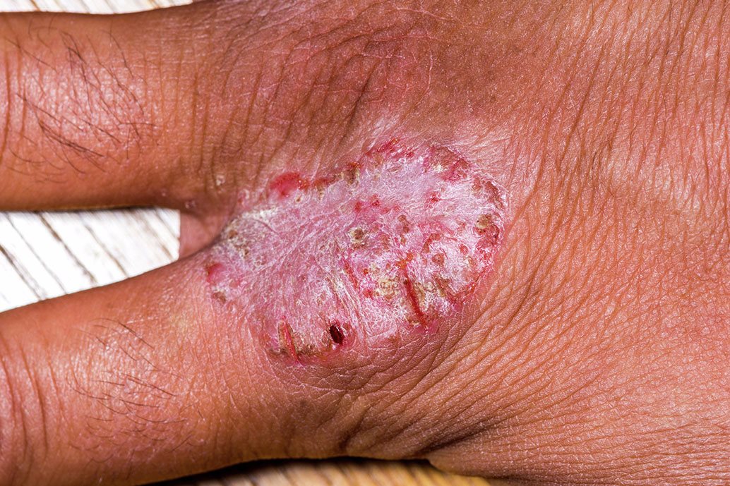 Lesione rotonda e desquamata da psoriasi pustolosa localizzata al centro del palmo della mano giovane donna.