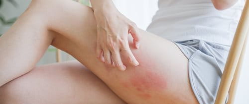 Frau kratzt sich am Unterschenkel mit roten Flecken