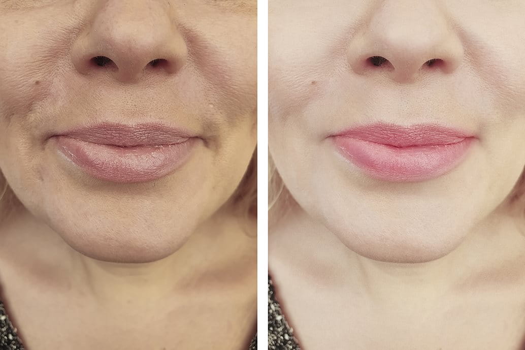 biorivitalizzazione viso prima e dopo